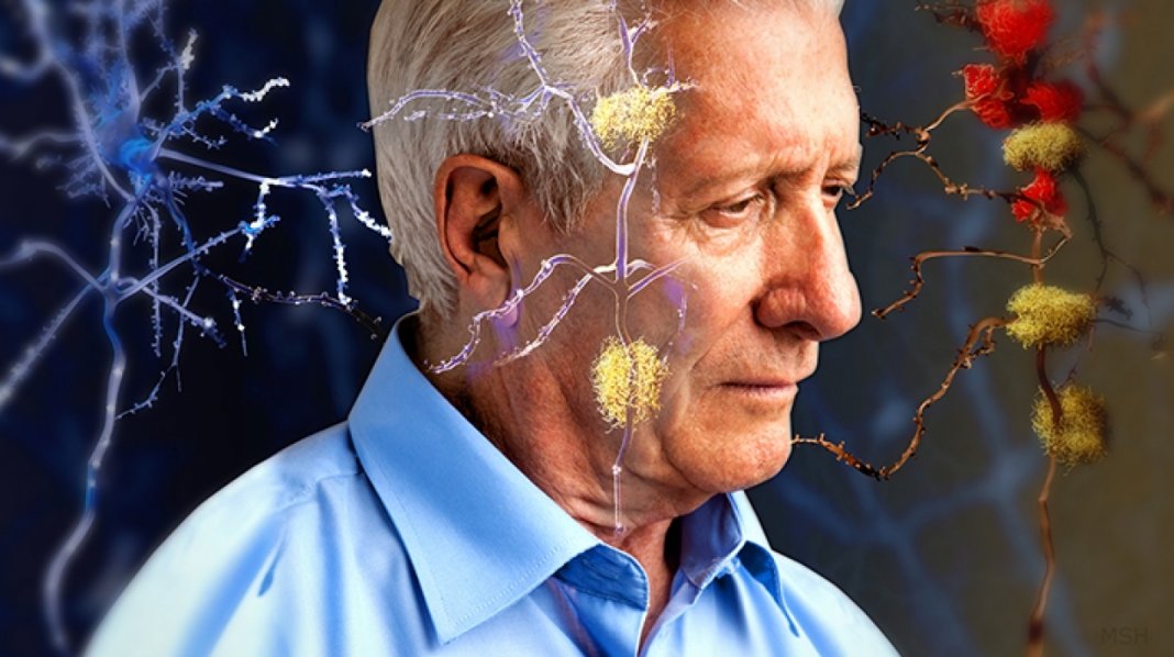 Novo medicamento contra o Alzheimer pode reduzir progressão da doença em 35%